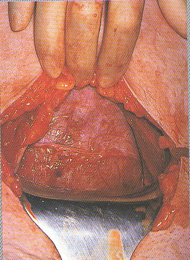 Exposure of the uterus (source) 