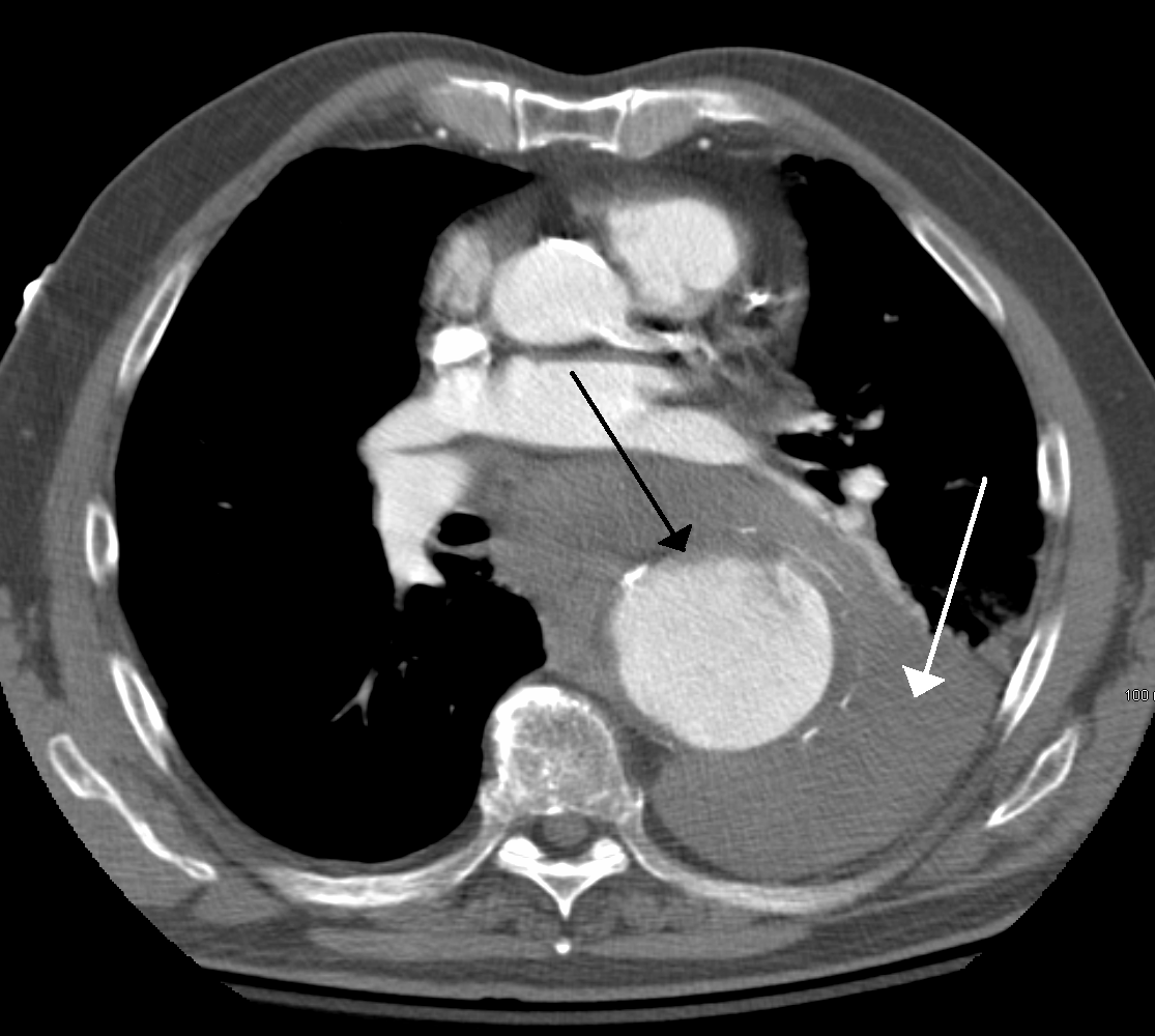 The IV contrast CT scan shows an TAA (black arrow) that has ruptured (white arrow, source)