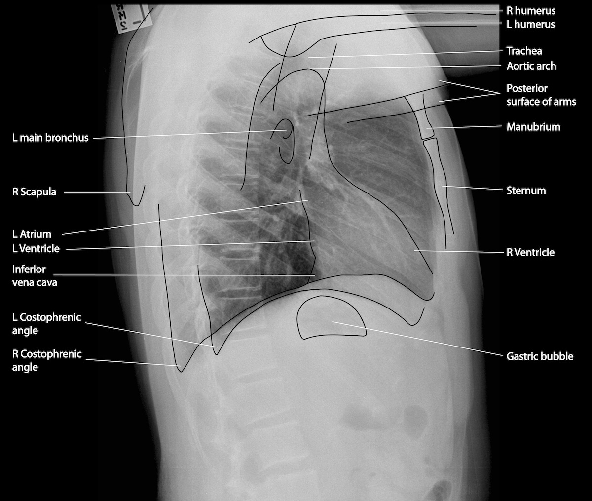 Anatomical landmarks on a later chest X-ray (source) 