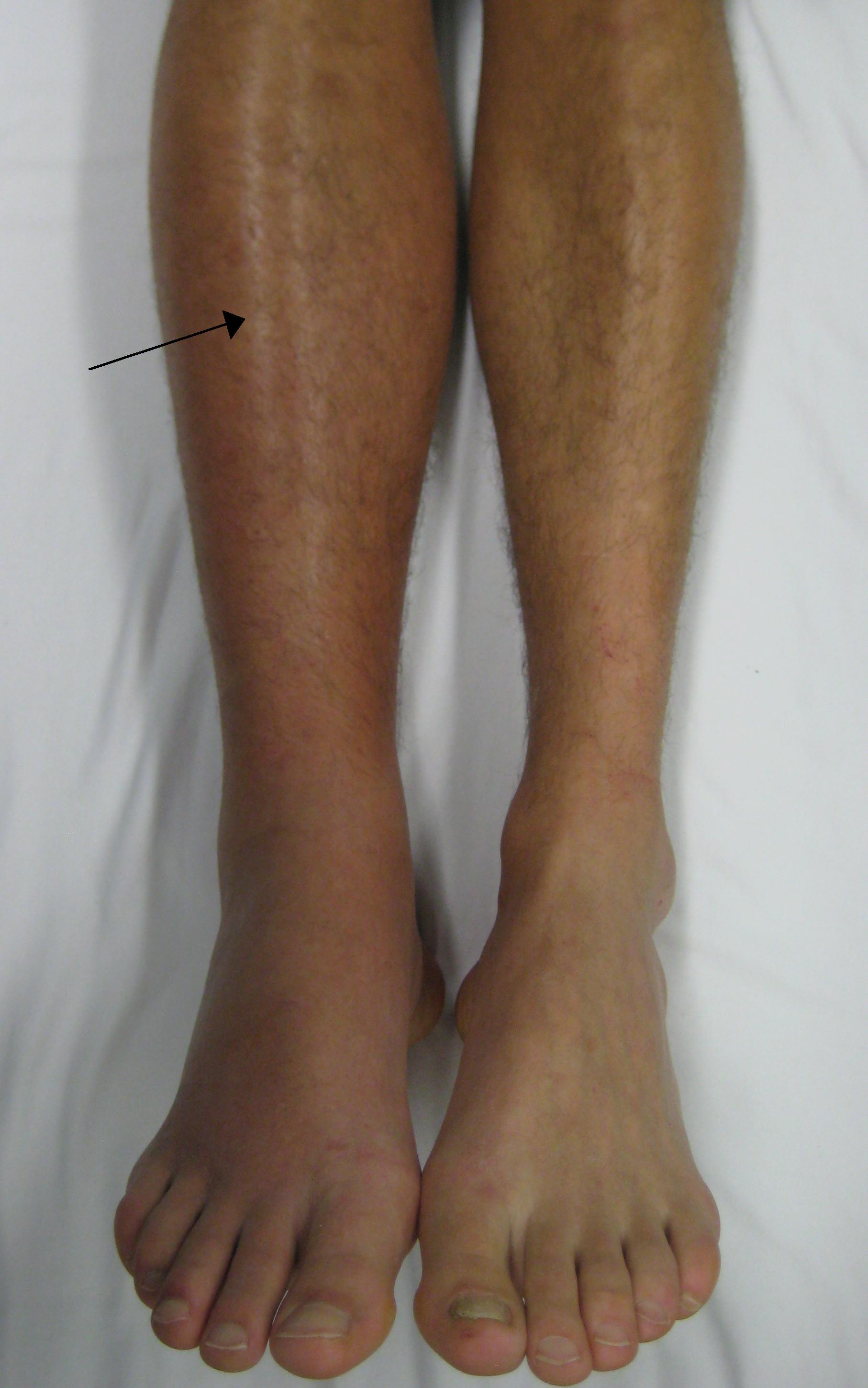 Physical appearance of a patient who has a DVT in the right lower leg (source) 