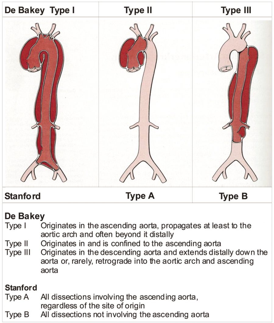 Aortic Dissection Stepwards