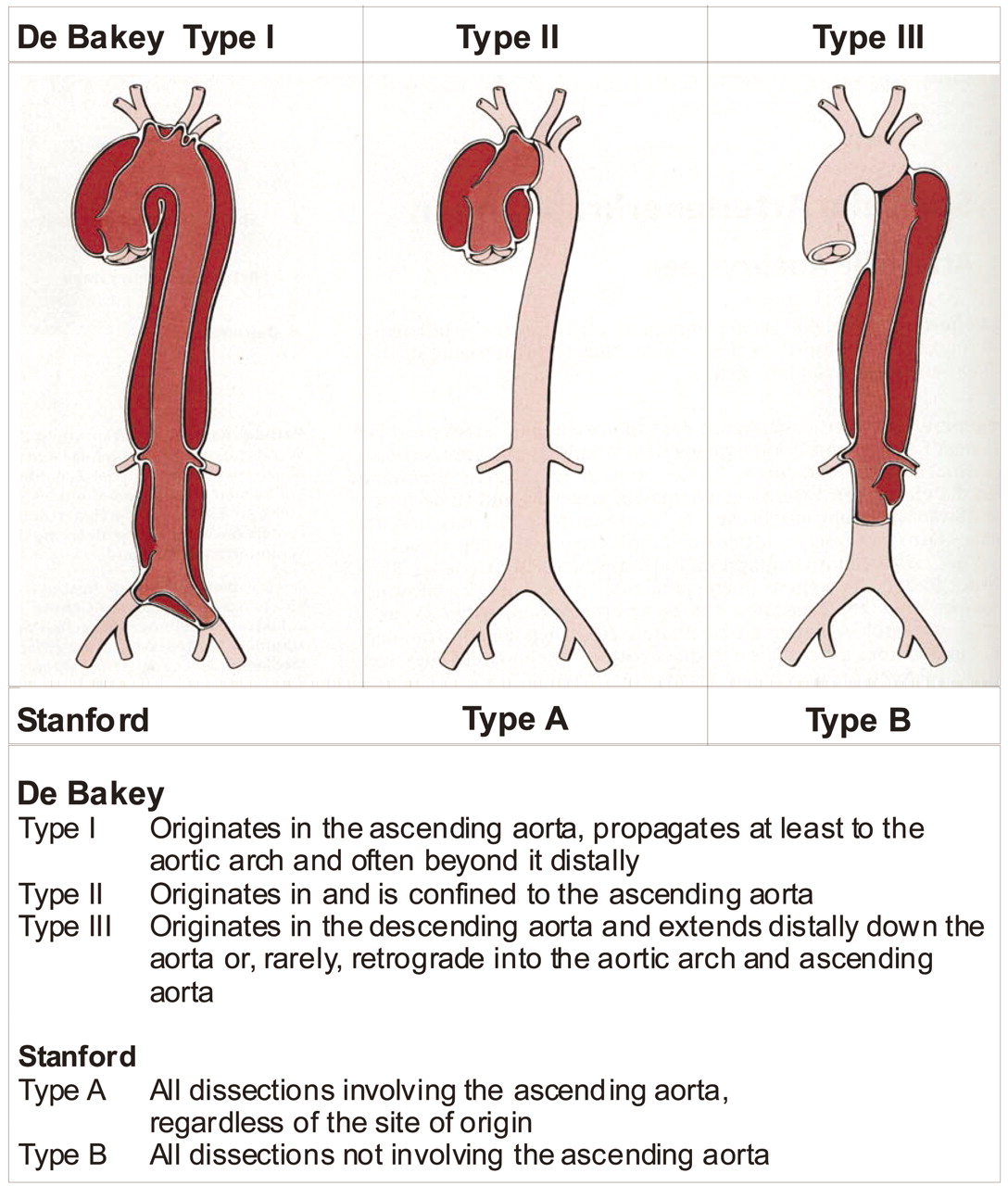 Aortic Dissection Stepwards aortic-dissection-stepwards