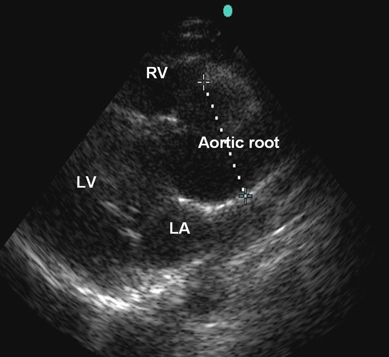 Measuring the size of the aortic root on an echo (shown above) can reveal its dilation. This increases the suspicion for TAA (source)