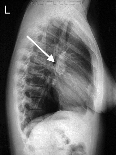 The hilar region is also an important one to assess for the presence of masses (unremarkable X-ray above for reference, source). 