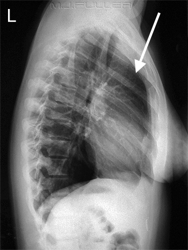 The retrosternal space normally should be "clear" as is depicted above. The presence of increased "white" in this area can be concerning for abnormal pathology (source)