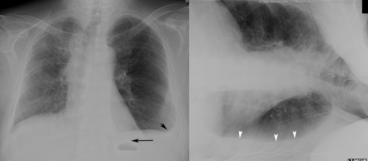 In these images a small pleural effusions is seen on the upright X-ray (left pane). When the patient is put in the LLDP layering of the fluid is observed (right pane, source).