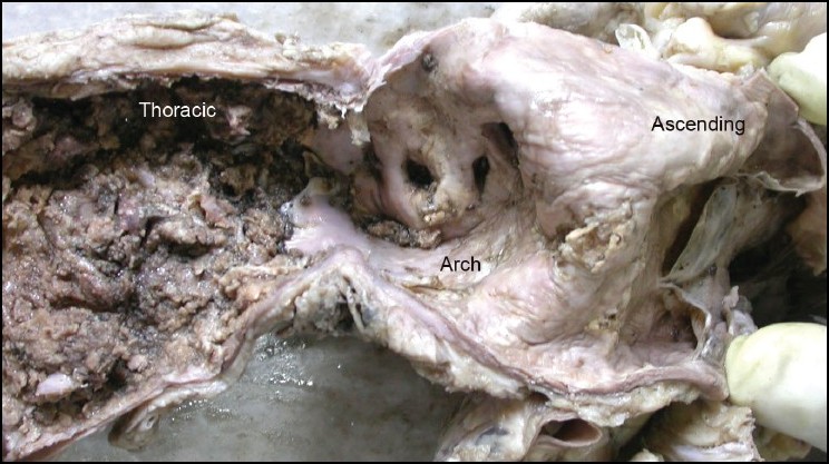 Tree bark aorta in a patient with syphilitic aortitis (source) 