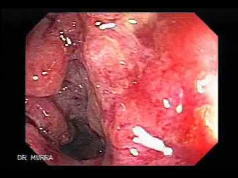 Visual appearance of internal hemorrhoids on anoscopy (source) 