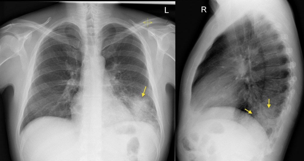 In the above image a left lower lobar pneumonia can be seen on both PA and right lateral views (source)