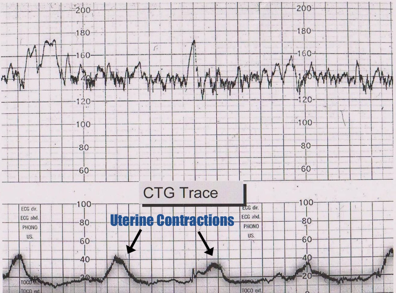 Uterine contractions are shown on the bottom topography reading (source). 
