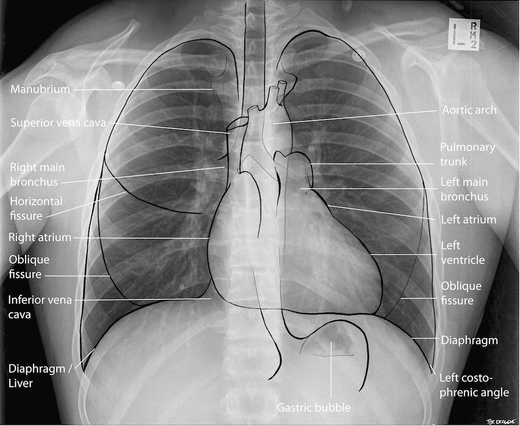 Anatomical landmarks on a PA chesty X-ray (source)