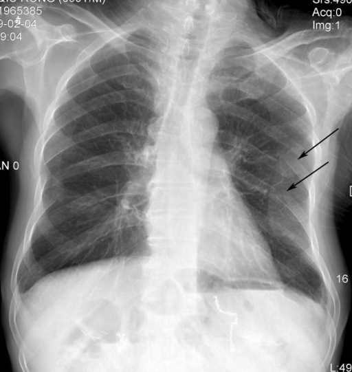 Rib fractures (arrows) seen on a chest X-ray (source). 