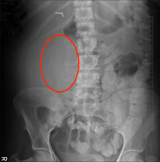 The appearance of the KUB above suggests the presence of a a large soft tissue density in right lumbar region. The loss of right psoas shadow, blurring of preperitoneal fat planes, displaced bowel loops, and mild scoliosis of spine all support this conclusion. 