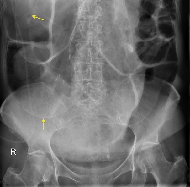 Clear examples of Rigler's sign can be seen on the image above (source) 