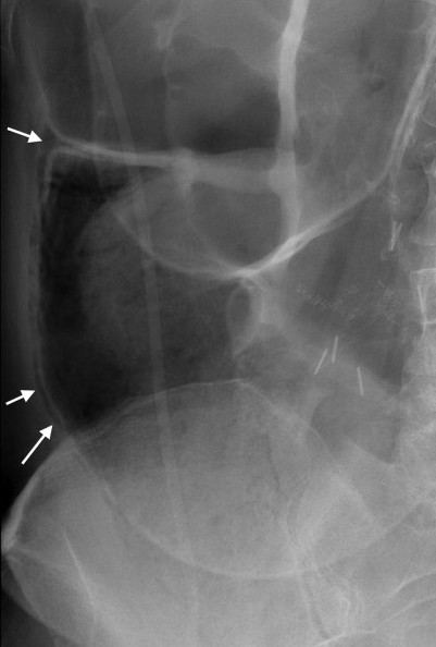 While sometimes subtle, pneumatosis can be appreciated in the X-ray above (source) 