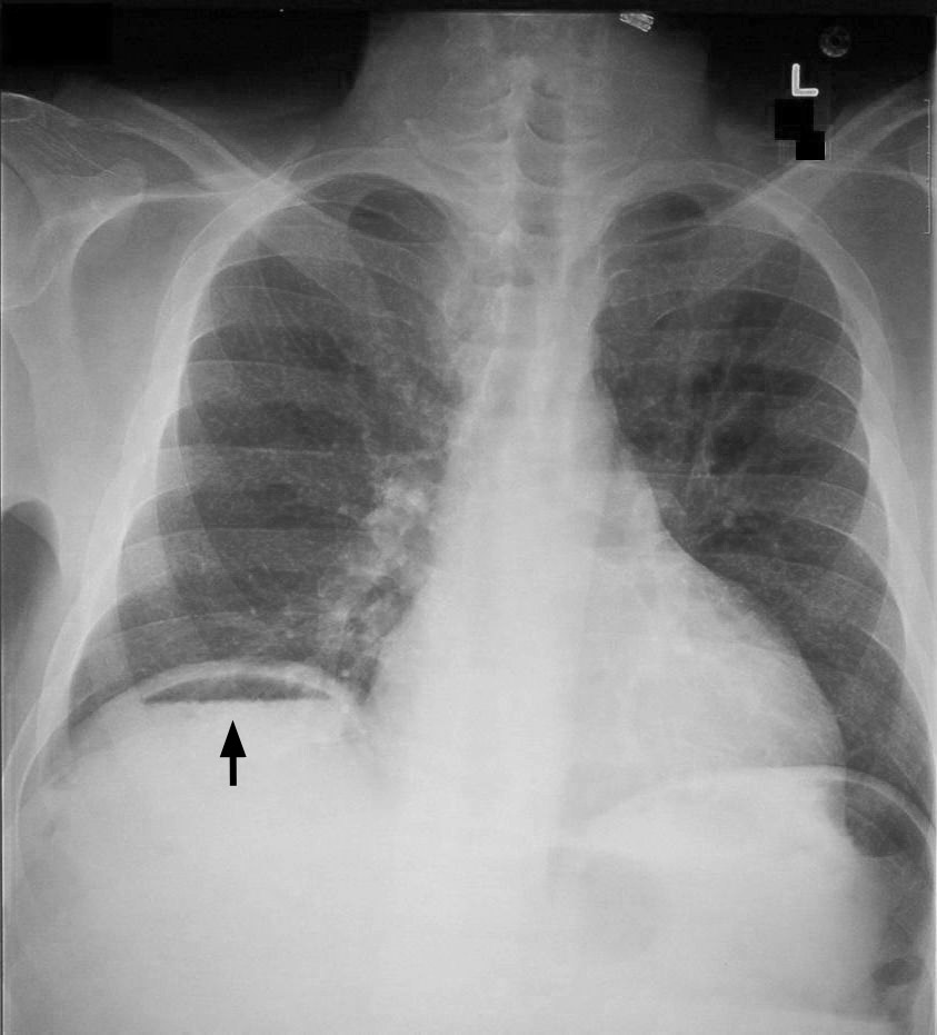 Air under the diaphragm (as depicted above) is a clear indicator of intraperitoneal free air. 