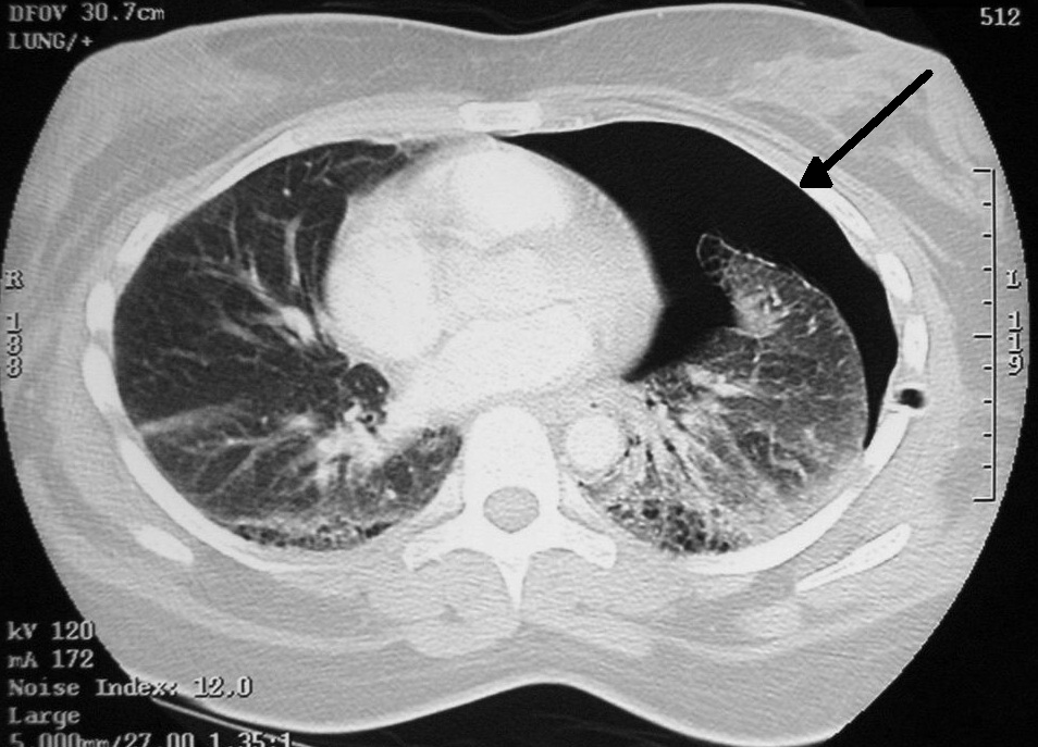 CT- scan showing the presence of air in the pleural space around the left lung (source) 