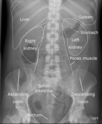 Anatomy of an abdominal X-ray (source) 