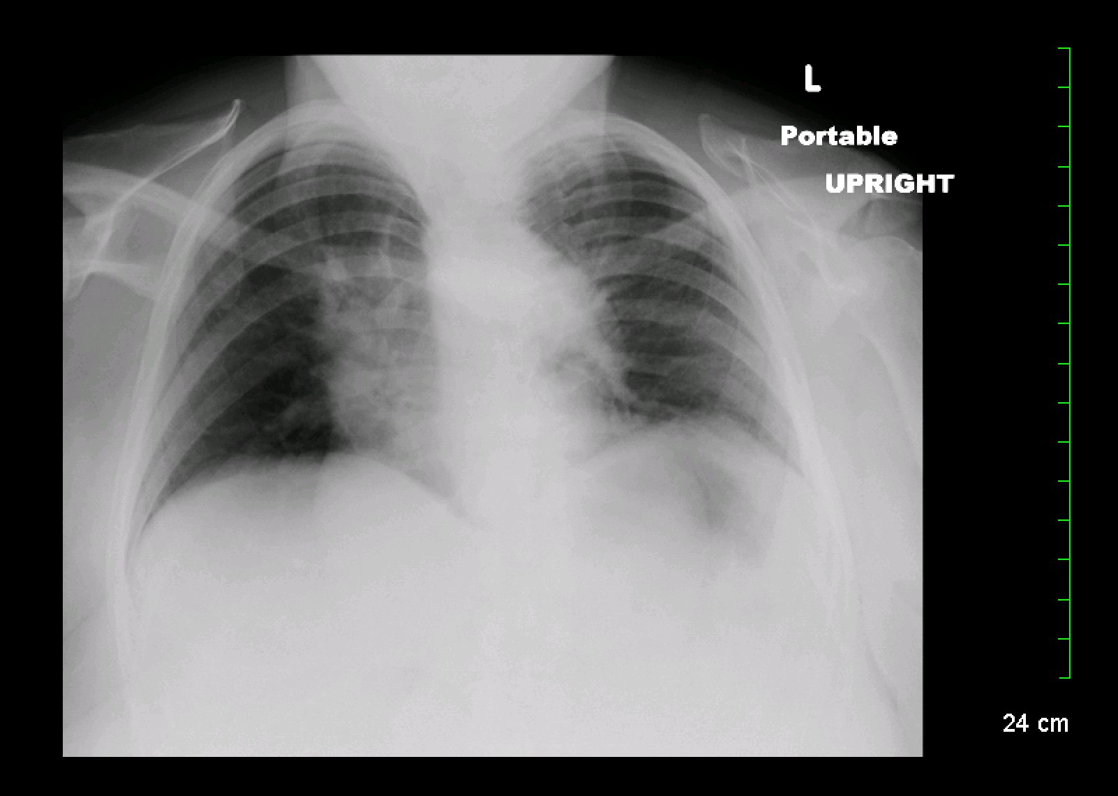 Angulation in this chest X-ray (appearance of ribs and clavicle show a patient who is "tipped back") makes it more difficult to interpret. 