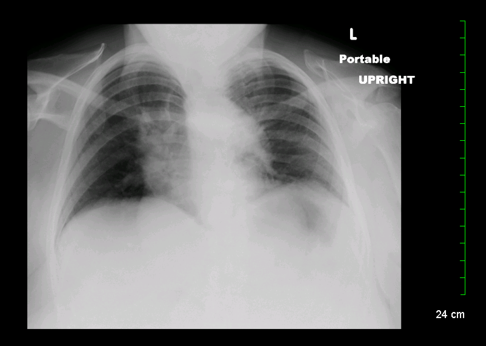 Angulation in this chest X-ray (appearance of ribs and clavicle show a patient who is "tipped back") makes it more difficult to interpret.