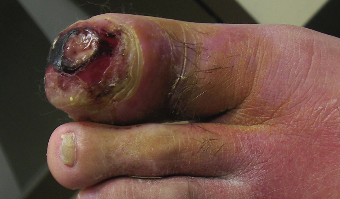 Visual external appearance of osteomyelitis of the toe (source)