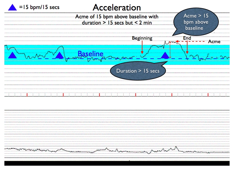 Characteristics of an acceleration on CTG/EFM (source)