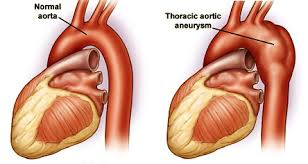 Anatomy of a thoracic aortic aneurysm (source) 