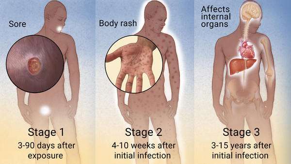 syphilis stages diagram