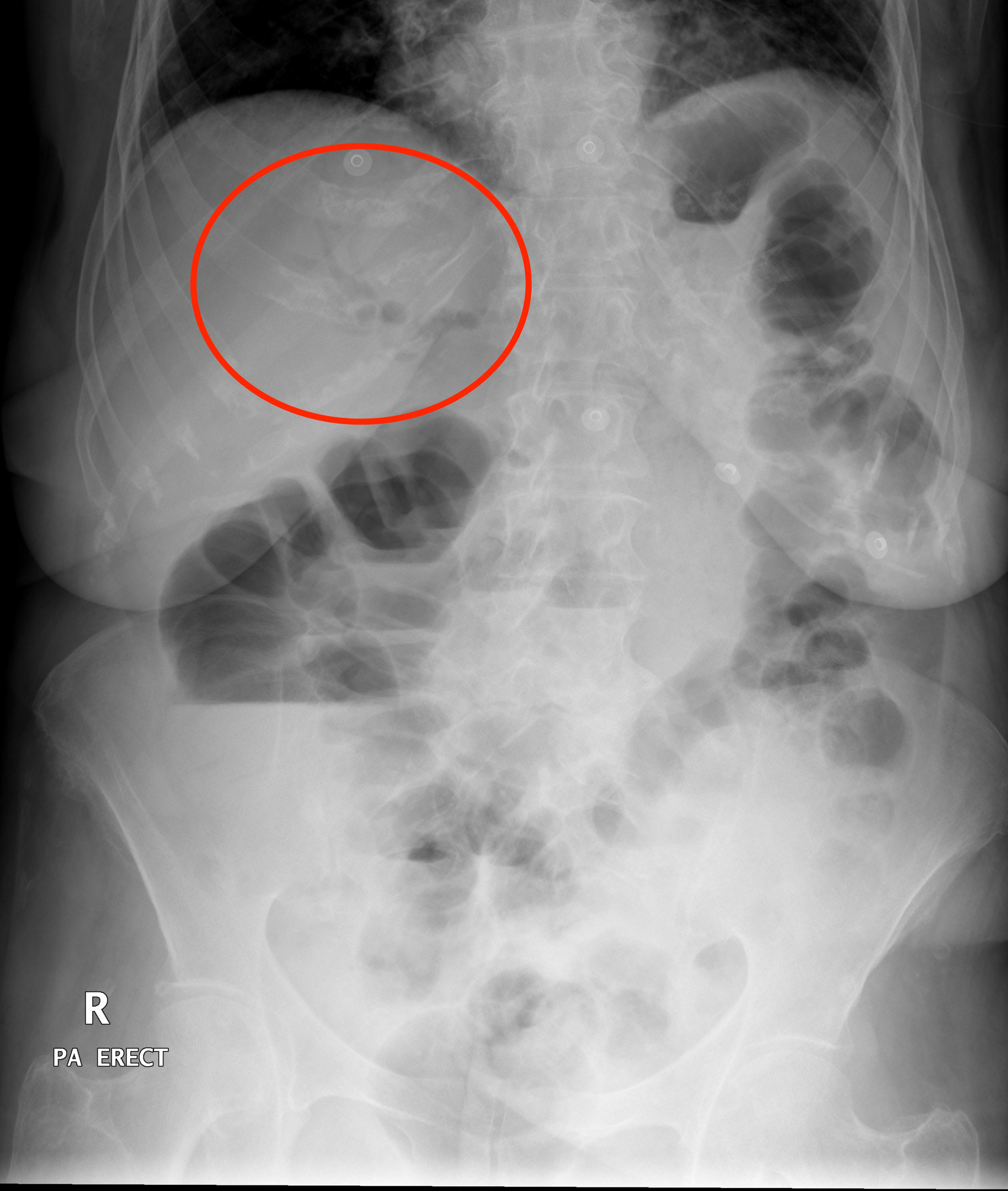 Detection of pneumobilia on abdominal X-ray (source)