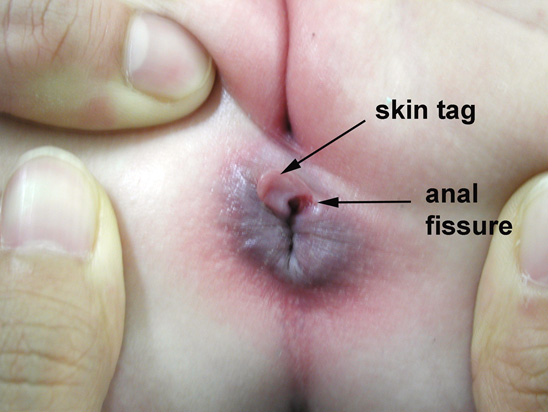 Visual appearance of a anal fissure and associated skin tag (source) 
