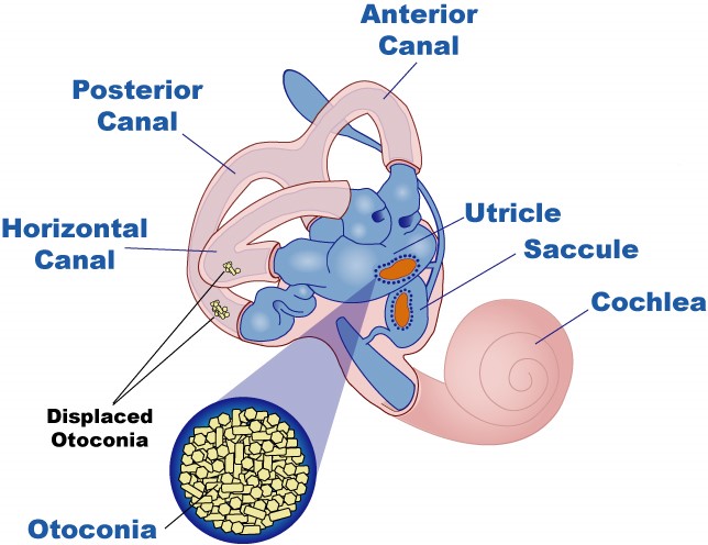 Displaced otoconia/particles within the ear are thought to be the cause of BPPV (source) 