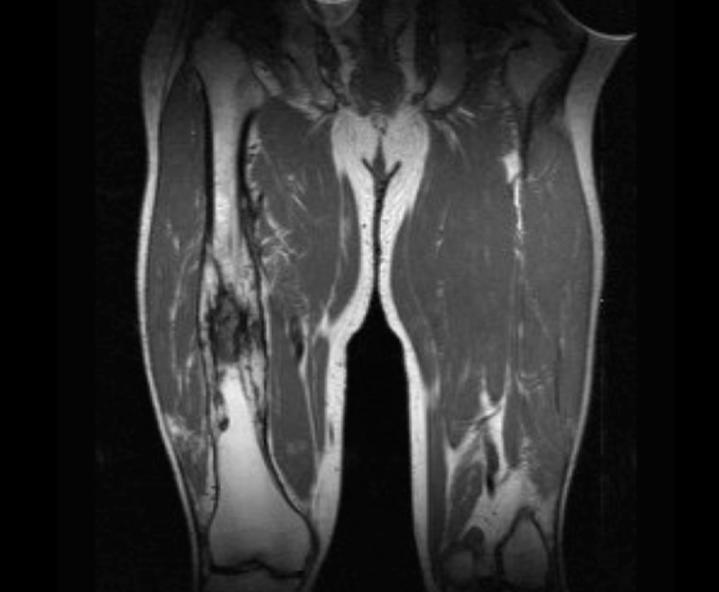 MRI imaging showing osteomyelitis of the right femur (source) 