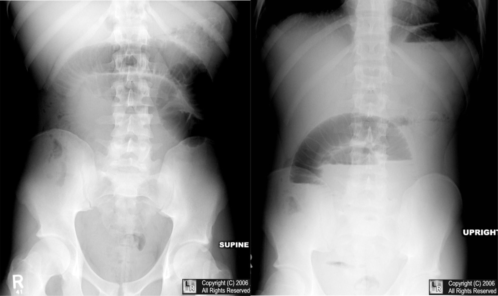 The supine view demonstrates the presence of dilated bowels, while the upright view shows air/fluid interfaces. These both suggest small bowel obstruction in this patient (source) 