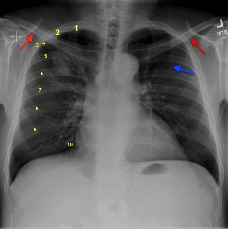 Counting ribs is an important measure of proper inspiration. In this patient 10 ribs can be seen. The 1st and 2nd ribs are sometimes difficult to distinguish (source) 