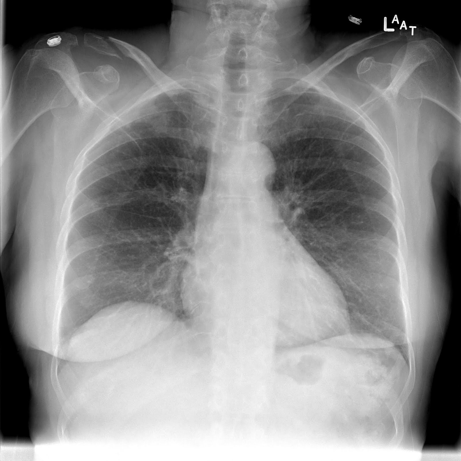 Clear fracture of the right clavicle seen on chest X-ray (source) 