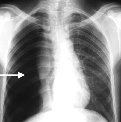 Right pneumothorax seen on chest X-ray. The absence of lung markings on the right side are used for this diagnosis (source)