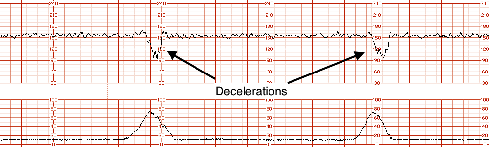 Example of decelerations on EFM tracing (source) 