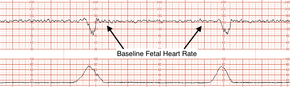 The baseline fetal heart rate on this EFM strip is ~160 bpm (source)