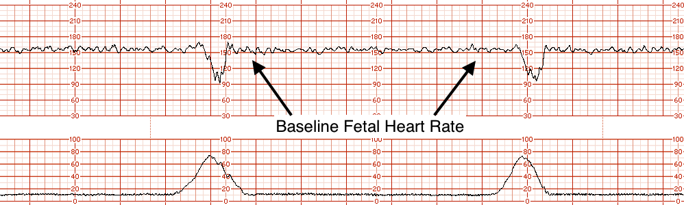 A Guide To Electronic Fetal Monitoring Cardiotocogram Stepwards