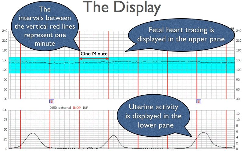 Fetal Heart Rate: Normal Range and How to Monitor It at Home