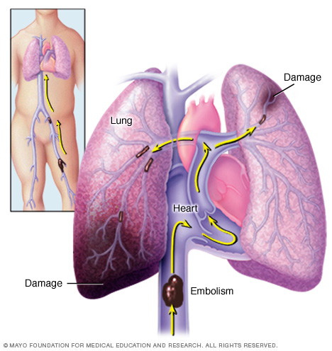 Anatomy of a pulmonary embolism (source) 
