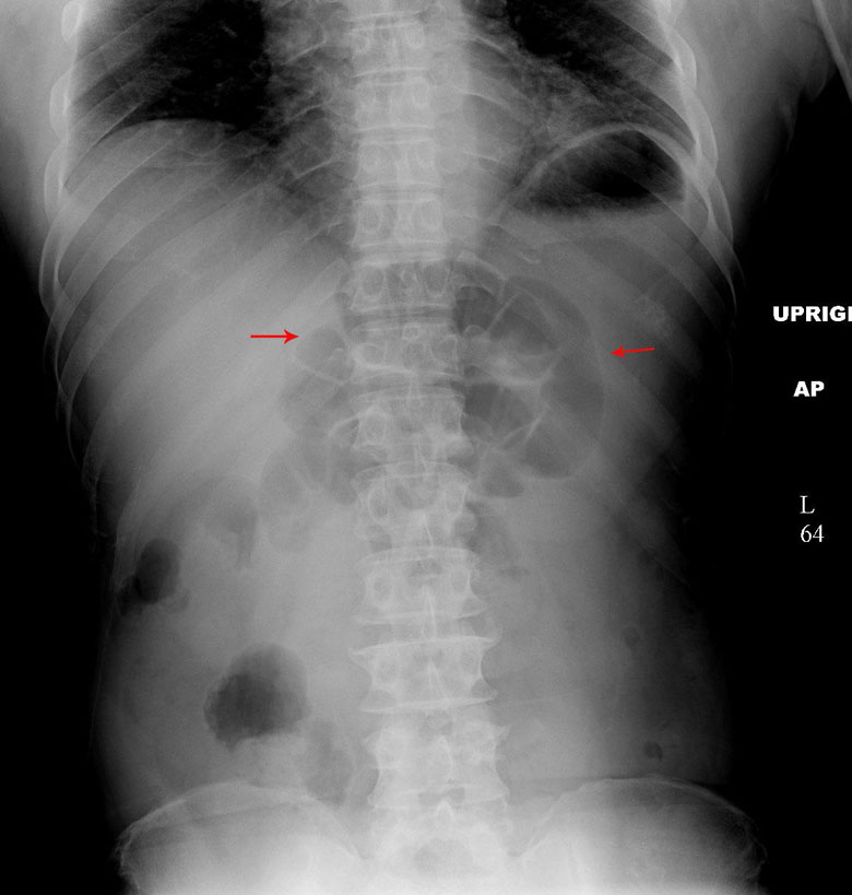 KUB demonstrating focal/localized ileus (source) 