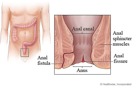 Anatomical location of an anal fissure (source) 