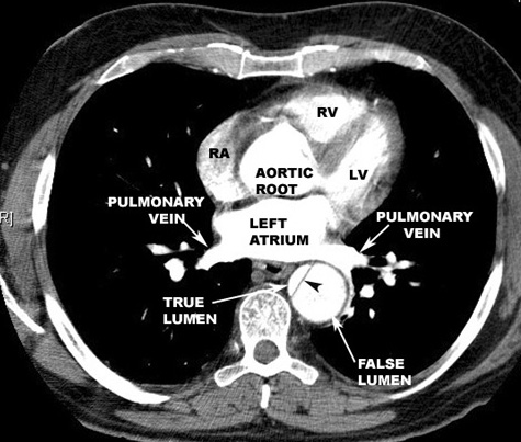 Large aortic dissection made evident by the presence of the false lumen adjacent to the true lumen of the aorta (source) 