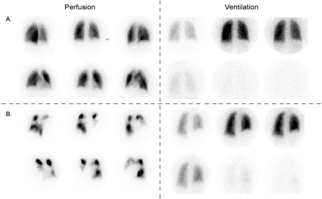 V/Q scans in a patient with very low likelihood of PE (A) and a high likelihood of PE (B). Note the poor perfusion in pane B (source) 