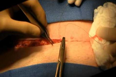 Closure of skin at the end of a Cesarean section (source) . 