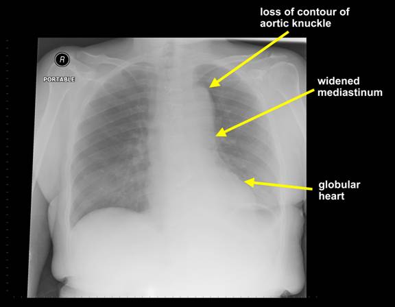 Numerous X-ray findings (outlined above) can be seen in a patient with an aortic dissection (source) 