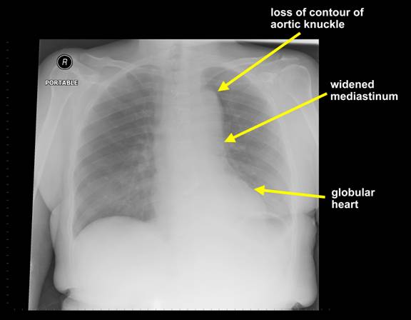 Aortic Dissection Stepwards