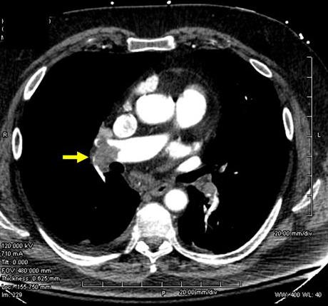 In the image above a embolus in the right pulmonary artery can be seen that blocks blood flow in this artery (source) 