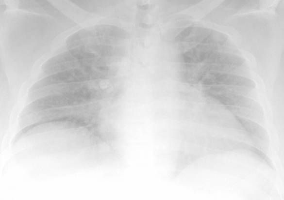 This image shows a clearly underpenetrated chest X-ray. It is very difficult to interpret such a film (source)